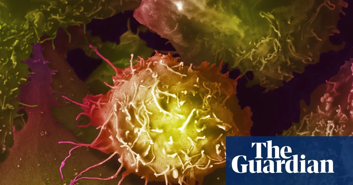 UK Expert Panel Rejects Routine Prostate Cancer Screening for Most Men