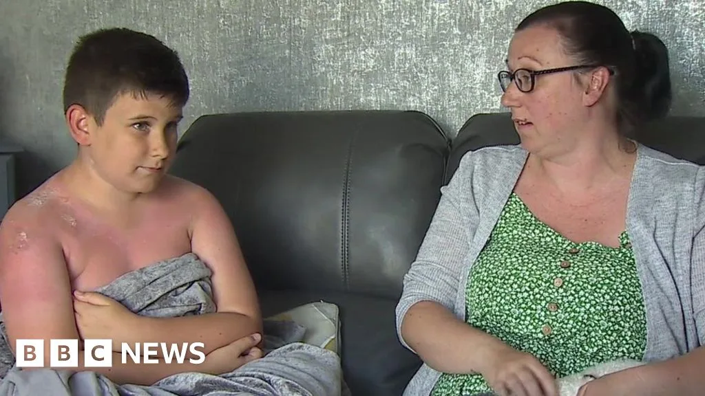 Wales Braces for 38C Heat as Mother Warns of Sunburn Dangers