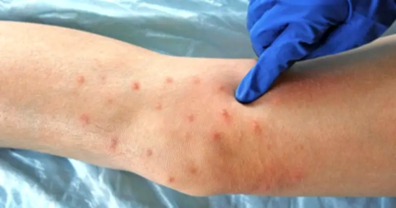 UKHSA Reports Two Measles Deaths as Virus Continues Spread