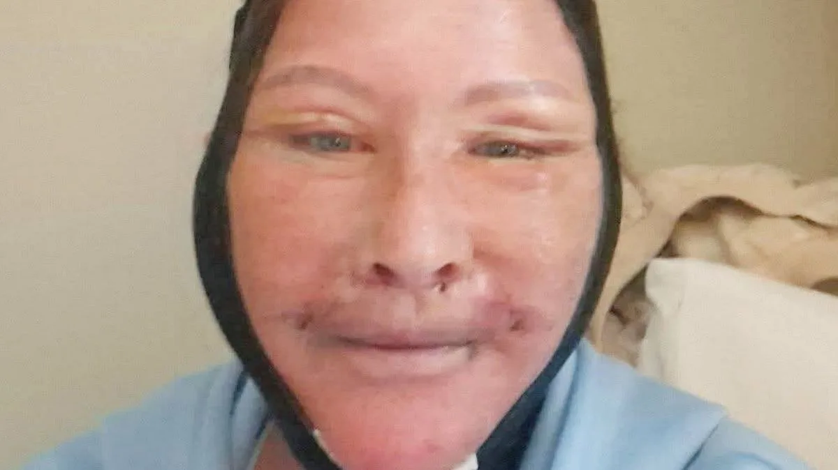 Woman, 54, Hits Back at Trolls After £6k Turkey Facelift Taunts