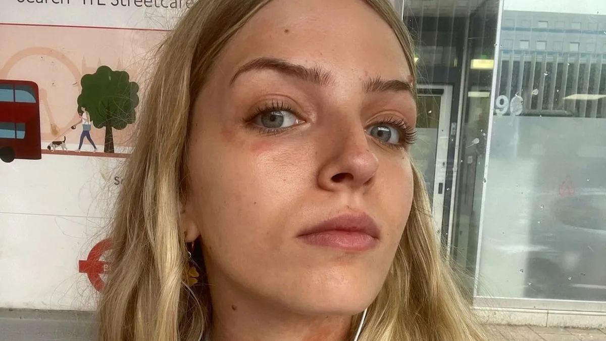 Woman’s ‘Cold’ After Pub Visit Turns Out to Be Victorian Disease Scarlet Fever