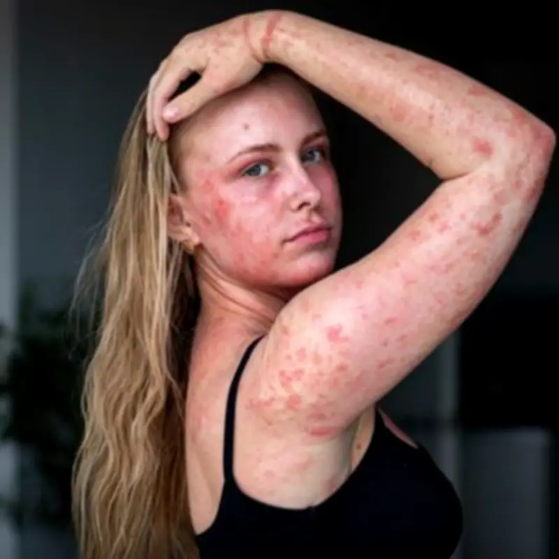 Woman's Skin Feels Like Acid After Steroid Creams for Eczema