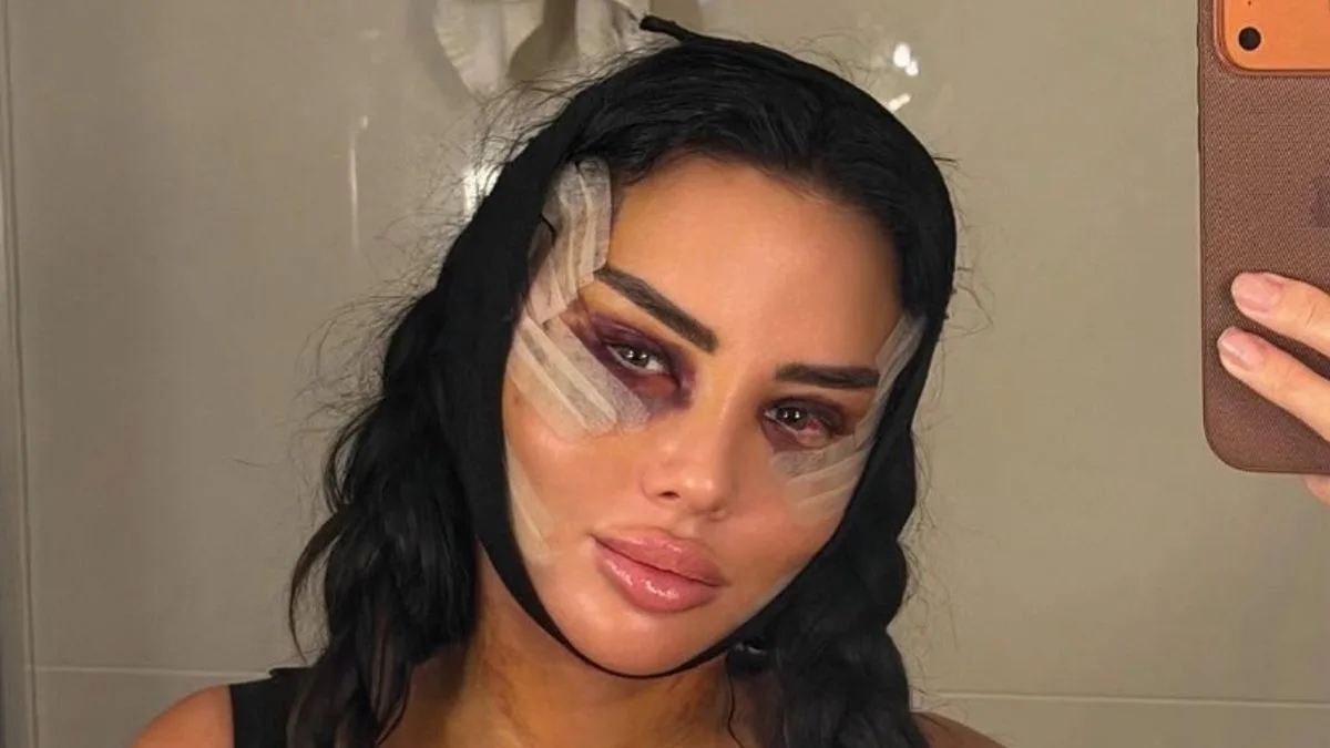 TOWIE Star Yazmin Oukhellou Shows Bruised Facelift After Turkey Procedure