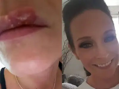 Mum Says Daughter 'Hasn't Had a Single Cold Sore' Since Using £9 'Miracle' Balm