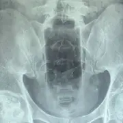 Doctors remove 20cm bottle from man's rectum after cleaning mishap