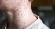 Measles Kills 2 Children in England: Expert Urgent Warning to Parents