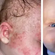 Mum 'astonished' by £2 balm that cleared baby's eczema in days