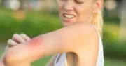 NHS Urges Ice Packs for Insect Bites During UK Heatwave