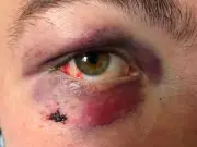 Teen beaten black and blue at TRNSMT by mob of youngsters
