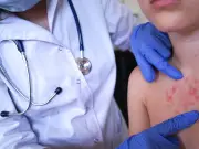 Two Children Die as Measles Spreads Across UK, UKHSA Confirms
