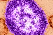 Two Children Die from Measles in England as Cases Rise in London