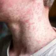 UK Measles Update: Urgent Warning to Parents as Over 100 New Cases Confirmed