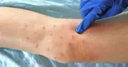 UKHSA Reports Two Measles Deaths as Virus Continues Spread