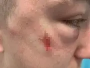West Lothian teen attacked with hammer at bus stop, suffers broken eye socket
