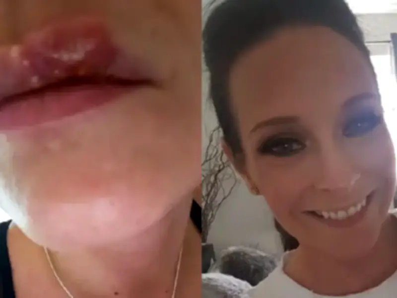 £10 Lip Balm Stops Cold Sores for 4 Years, Users Say