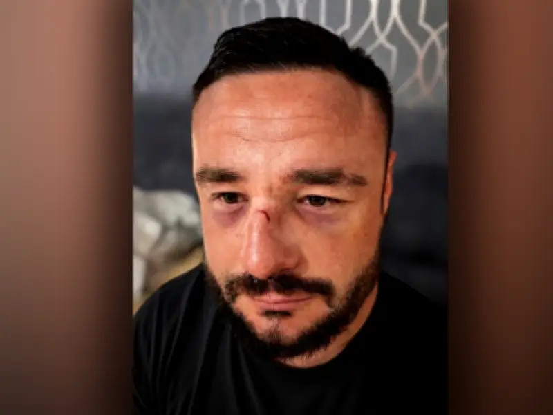 Gay Village Attack Victim Left with Permanent Scar as Case Closed