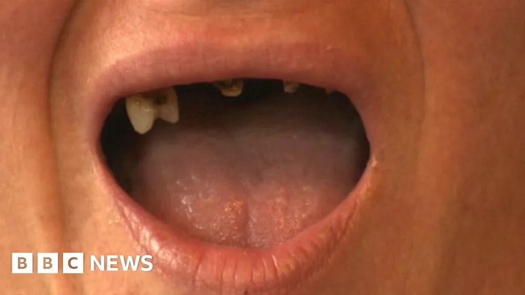 NHS Dentistry Crisis: Millions Never Seen Dentist as Adults
