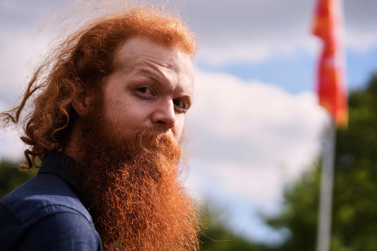 Red Hair Gene May Unlock New Treatments for Chronic Wounds