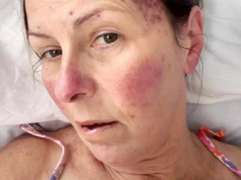 Woman Mistook Leukaemia Symptoms for Menopause, Then Fought for Life