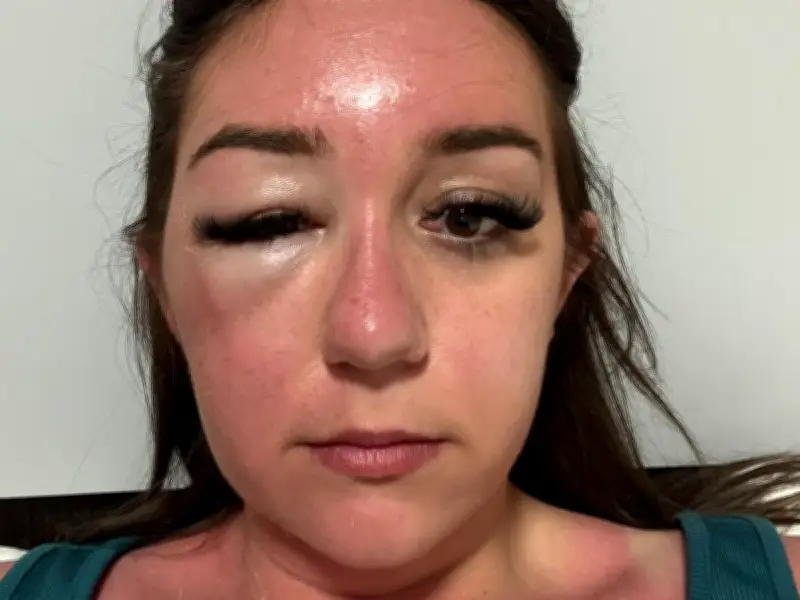 Woman Stranded in Greece After Mysterious Eye Infection