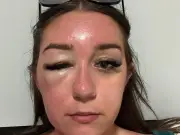 Brit Holidaymaker's 'Eye Bags' Lead to Mystery Illness Trapping Her in Greek Hospital for 9 Days